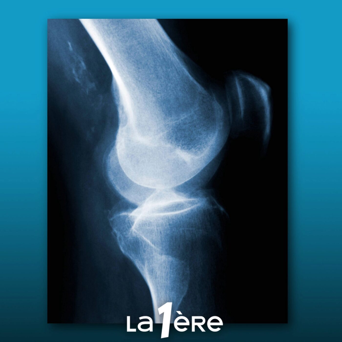 Quel rôle joue notre alimentation dans la prévention de l’arthrose ?