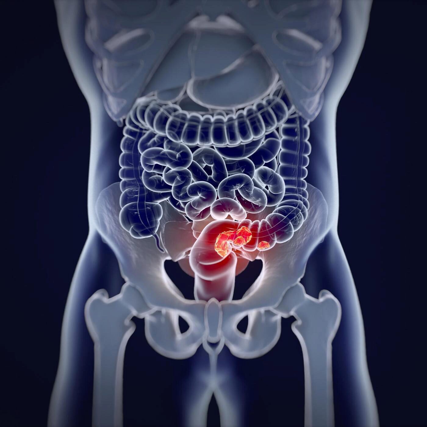 Le cancer colorectal, l'émission 36,9, de nouvelles plantes et les océans