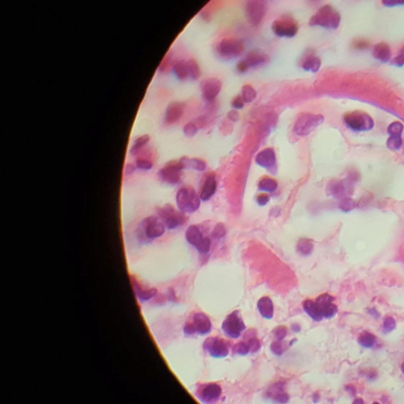 Un orteil bien pratique et une maladie entrainant des fausses couches