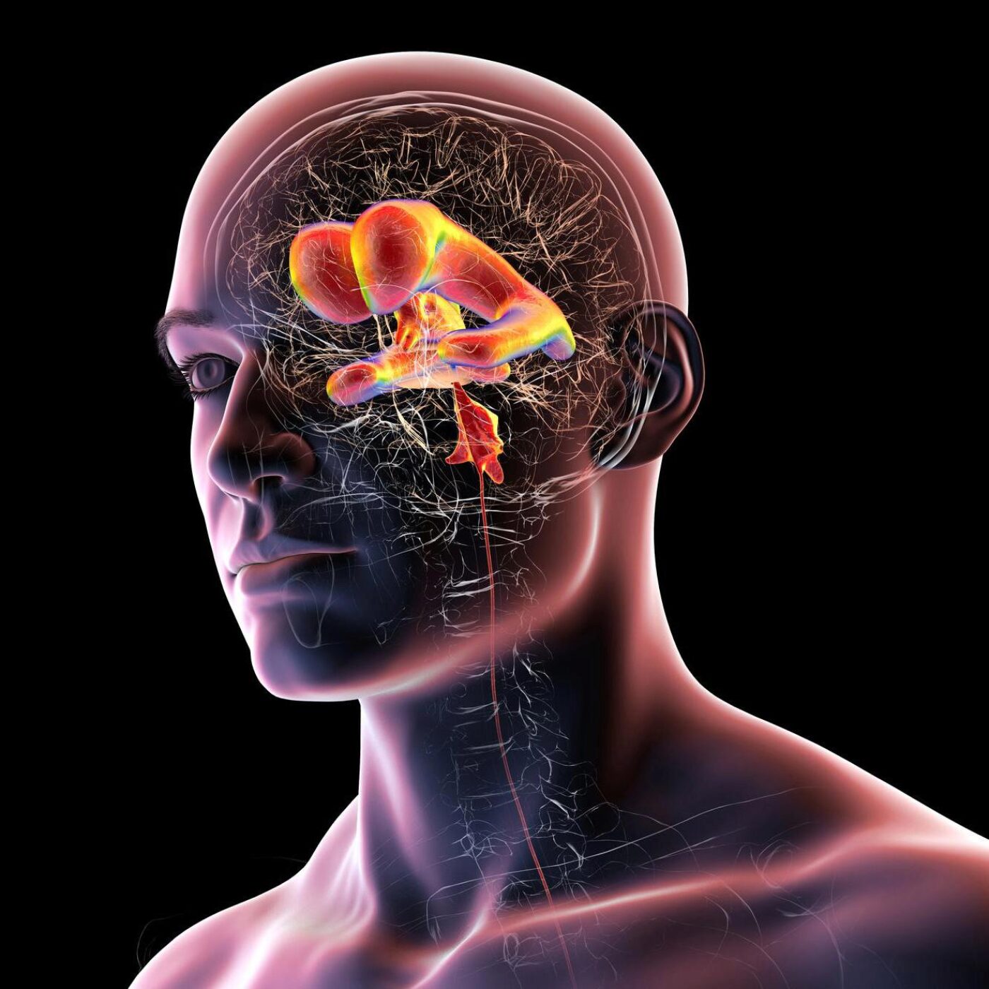 L'hydrocéphalie à pression normale, des implants, des cératures et des stimuli sonores